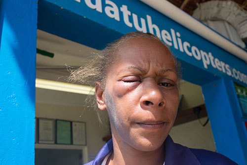 Florence Lengkon as she appeared after the brutal assault against her on March 13. Image: Dan McGarry/Vanuatu Daily Post