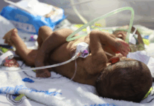 ‘We’re running out of time’: PNG parents in desperate plea to save conjoined twins PNG's conjoined twins
