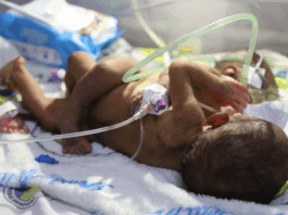 ‘We’re running out of time’: PNG parents in desperate plea to save conjoined twins PNG's conjoined twins