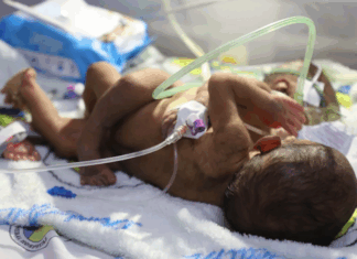 PNG's conjoined twins