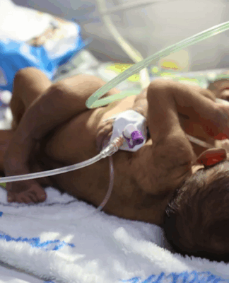 PNG's conjoined twins