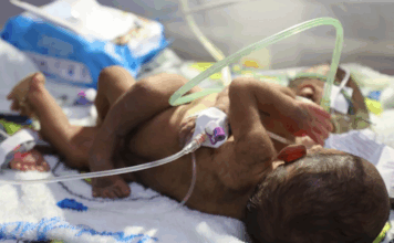 ‘We’re running out of time’: PNG parents in desperate plea to save conjoined twins PNG's conjoined twins