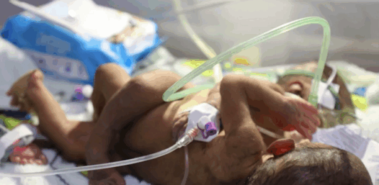 ‘We’re running out of time’: PNG parents in desperate plea to save conjoined twins PNG's conjoined twins