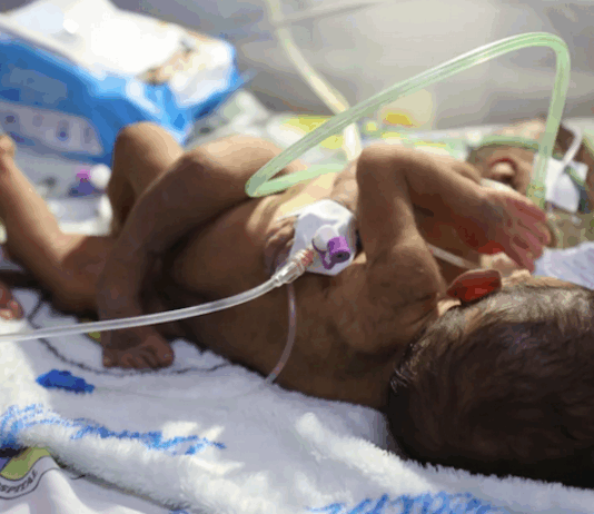 PNG's conjoined twins