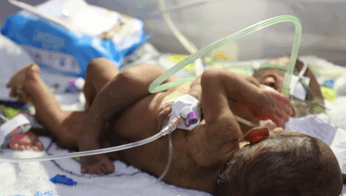 PNG's conjoined twins