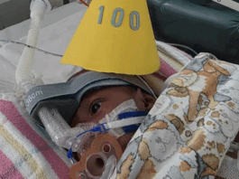 Conjoined twin Sawong from PNG wears a party hat