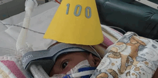 Conjoined twin Sawong from PNG wears a party hat