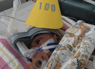 ‘Thank God’ – parents of PNG conjoined twins grateful they defied medical advice Conjoined twin Sawong from PNG wears a party hat