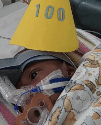 Conjoined twin Sawong from PNG wears a party hat