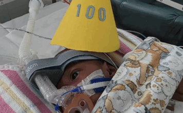 ‘Thank God’ – parents of PNG conjoined twins grateful they defied medical advice Conjoined twin Sawong from PNG wears a party hat