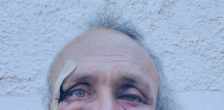 Julien Blondel’s face . . . bloodied but unbowed