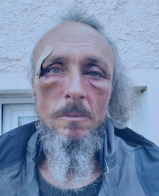 Julien Blondel’s face . . . bloodied but unbowed
