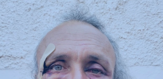 Julien Blondel’s face . . . bloodied but unbowed