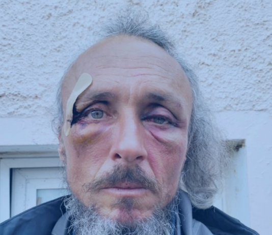 Julien Blondel’s face . . . bloodied but unbowed