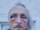 Julien Blondel’s face . . . bloodied but unbowed